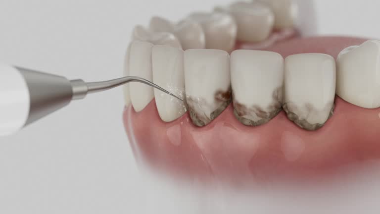 Reliable Wisdom Tooth Removal contractor in Ogden, UT by Smile Center Dentistry